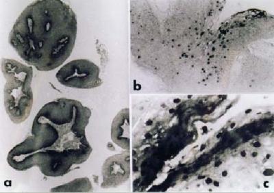 FIGURE 1: Histological section of laryngeal papillommatosis (Case 1) (Haematoxylin & eosin, a, x20). Cells containing HPV 6 DNA by in situ hybridisation, indicated by the dark-stained nuclei of the superficial cells (b, x40 & c, x400)